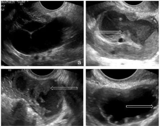 Figura 3 – (a) Mulher com  antecedentes de DIP. A imagem  de ecograia transvaginal  revela uma trompa de Falópio  dilatada, com parede ina  revelando septos incompletos  e conteúdo anecogénico, em  relação com hidrossalpinge  direita, uma possível sequela 