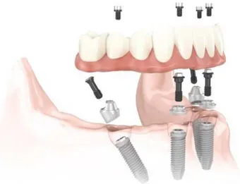 Figura 2 – Figura ilustrativa da técnica All-on-4 ®  (adaptado de 