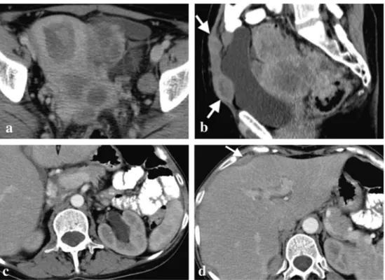 Fig. 5 a – d. Poorly differentiated endometrioid carcinomas of the left ovary and of the endometrium in a 56-year-old woman with Lynch syndrome