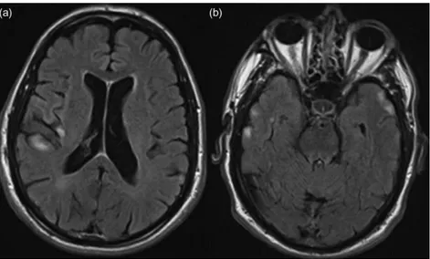 Figure 1. Brain magnetic resonance imaging, fluid attenuated inversion recovery – hyperintense lesions in right fronto-opercular, (a) right insular and (b) bilateral temporal cortex