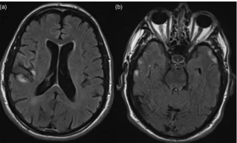 Figure 1. Brain magnetic resonance imaging, fluid attenuated inversion recovery – hyperintense lesions in right fronto-opercular, (a) right insular and (b) bilateral temporal cortex