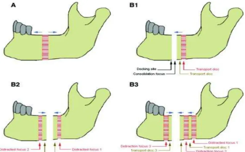 Figura 2: Duas variações da DO. A distração monofocal (A) baseia-se na regeneração óssea entre dois  segmentos que são separados cirurgicamente por uma osteotomia