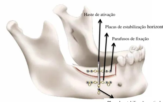 Figura 5: Distrator utilizado na DO alveolar constituído por uma haste de ativação, placas de  estabilização horizontal, placa de estabilização vertical e parafusos de fixação (Mazzonetto &amp; Maurette, 