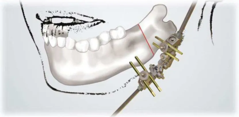 Figura 10: Distrator mandibular externo.  