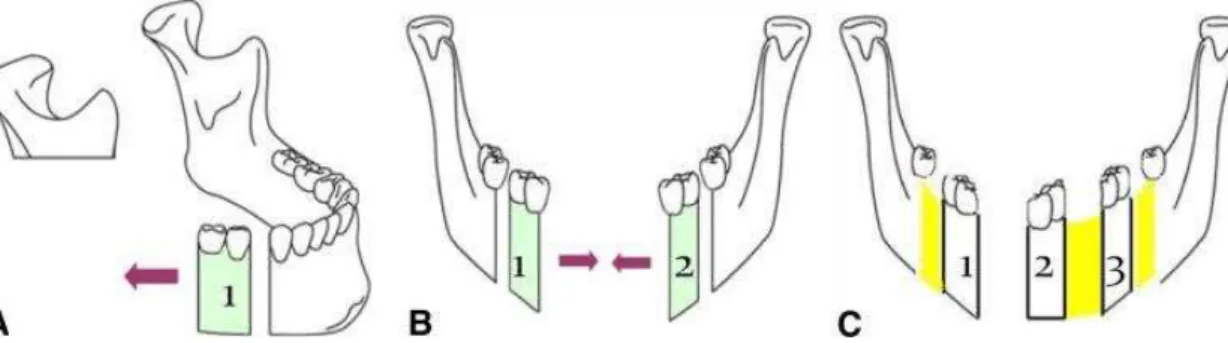 Figura 13: Tipos de distração óssea de disco de transporte: bifocal (A), trifocal (B), tetrafocal (C)  (Neelakandan &amp; Bhargava, 2012)