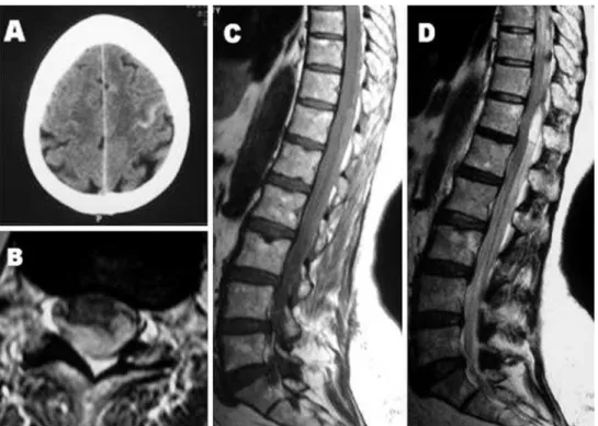 Fig. 1 a Transverse head CT image. Subdural hemorrhage over the cerebral sulci on the left frontoparietal convexity.