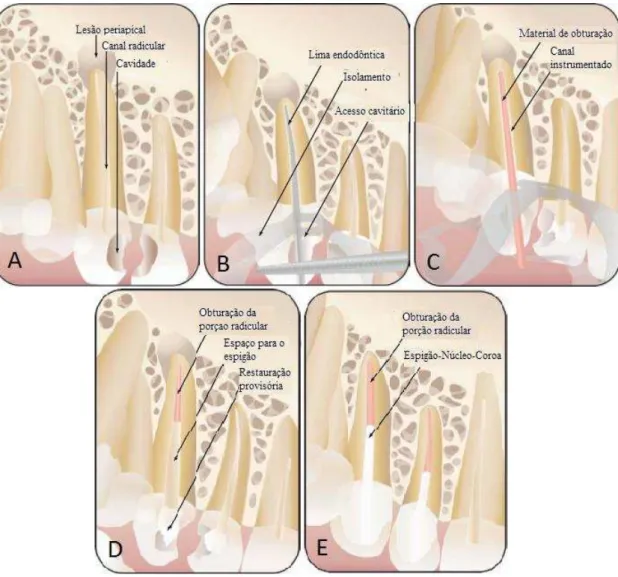 Figura 1  –  Representação de um plano de tratamento num dente com grande destruição coronária: 