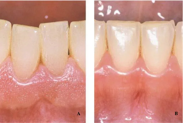 Figura 1: Diferença entre gengiva de textura pontilhada (A) e gengiva de textura lisa (B)