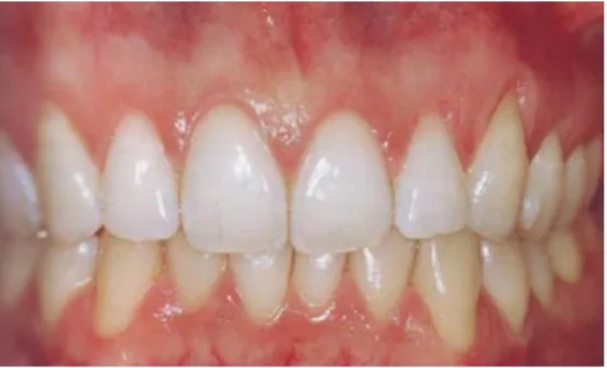 Figura 10: Exemplo de periodonto espesso e plano.