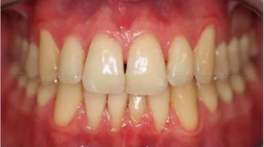 Figura 14: Exemplo de um periodonto fino e festonado