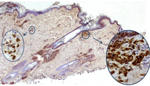 Figura 1 - Células dendríticas marcadas pelo anticorpo CD1c na pele lesionada de um cão  atópico  -  ABP,  Hematoxilina  de  Harris,  x40,  detalhes  x400  (Fotografia  gentilmente  cedida  pela Prof.ª Doutora Ana Mafalda Lourenço Martins)