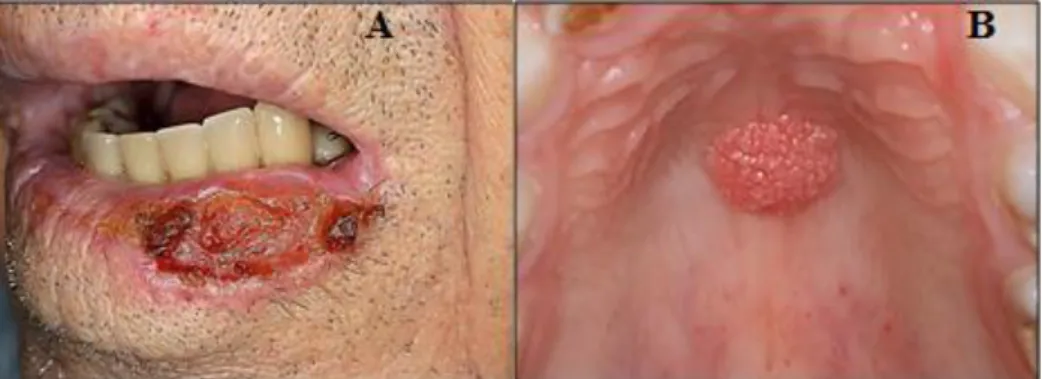 Figura 1. A: Úlcera maligna do lábio inferior. B: Lesão exofítica; papiloma escamoso. 