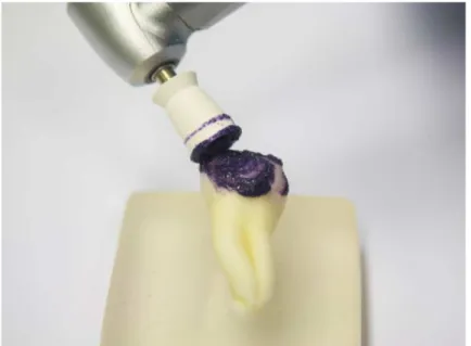 Figura 13 - Técnica de microabrasão com gel Opalustre ®  e taça de  borracha de profilaxia 