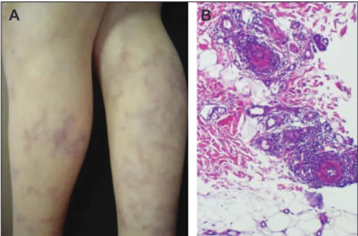 Figure 1. Livedo reticularis on the lower extremities (A).