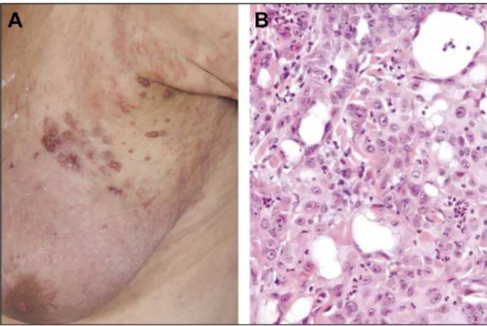 Figure 1. A) Zosteriform distribution of metastases on the left breast. B) Multiple irregular nests of pleomorphic cells with many atypical mitoses