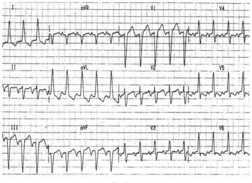 Figura 5. Exemplo de taquicardia devido a TRNAV rápida-lenta. Observa-se o intervalo RP longo