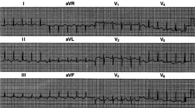 Figura 6. ECG de superfície que apresenta uma TRNAV atípica compatível com a forma lenta-lenta