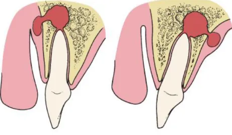Figura 1: Progressão da infecção consoante a distância do ápice dentário à cortical  óssea vestibular e palatina (Flynn, 2008) 