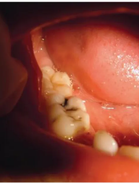Ilustração 3- Carie dentária num molar inferior do 4º quadrante 