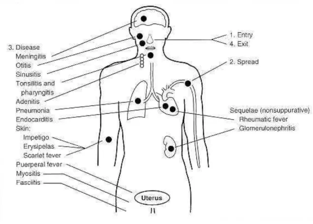 Ilustração  7- Sequelas devido a infecções por S. pyogenes (adaptado de Patterson in Peake et  al.,  1996) 