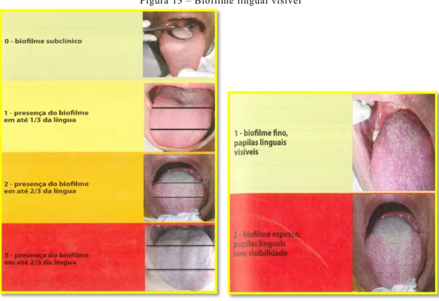 Figura 13 – Biofilme lingual visível