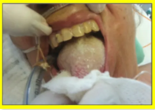 Figura 14 - Presença de biofilme lingual no paciente com intubação orotraqueal 