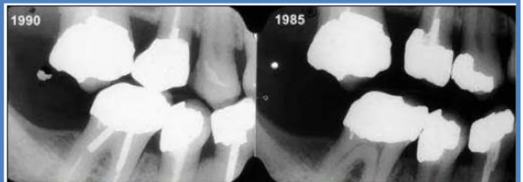 Figura 2  –  Exemplo de comparação de radiografias ante mortem (1985) e post mortem (1990) com o  objectivo de determinar uma identificação (retirado de Pretty &amp; Sweet, 2001)