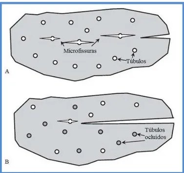 Figura 6  –  Ilustração esquemática das diferenças estruturais da dentina normal (A) e da dentina radicular  translúcida (B) (adaptado de Kinney et al., 2005)