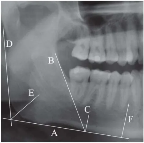 Fig 3-  Linhas  necessárias  para  a  obtenção  dos  índices    panorâmicos     A-  Linha  tangente  á  base  da  mandibula; B- Linha tangente ao bordo anterior do ramo; C- Linha perpendicular a A na altura em que  B passa na base da mandíbula; D- Tangente