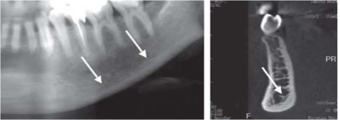 Fig 9-  Representação da junção do osso trabecular com córtex inferior  da mandíbula  (Taguchi, 2010) 