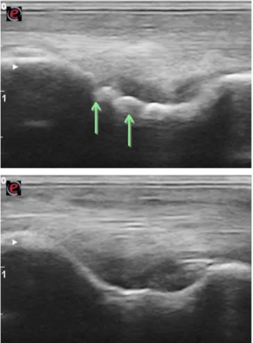 Figura 8- Imagens ecográficas (corte longitudinal) das zonas de inserção proximal do ramo  profundo dos ligamentos colaterais do boleto, da mesma articulação metatarsofalângica, na  fossa epicondilar do metatarsiano III.