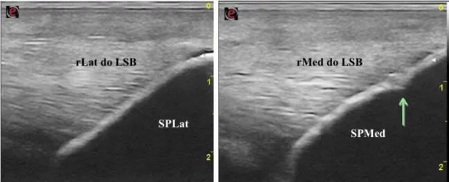 Figura 14- Imagens ecográficas (corte longitudinal) da zona de inserção dos ramos lateral e  medial do ligamento suspensor do boleto da mesma articulação metatarsofalângica, no ápex  dos ossos sesamóides proximais.