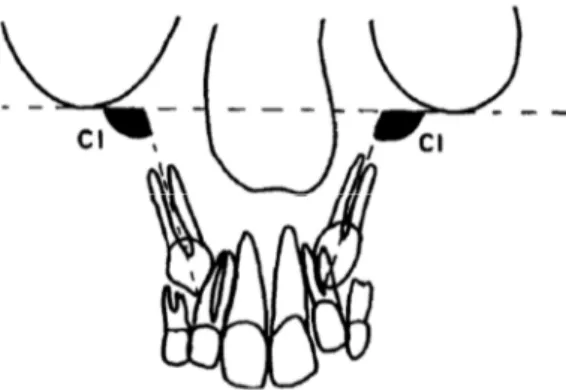 Figura  11 - Inclinação do canino (CI) é medida através do ângulo externo formado pelo eixo do canino e  a linha recta que passa através de dois pontos suborbitários (Fernández  et al