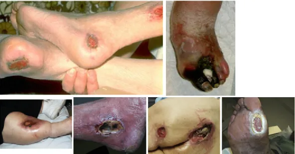 Fig. 1 - Pressure ulcers and wounds - adapted from [3, 4]. 