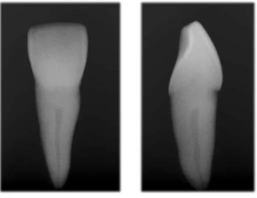 Figura 1. Radiografias digitais com incidência V-L e M-D, respetivamente, do espécime 16, confirmando  anatomia classe I