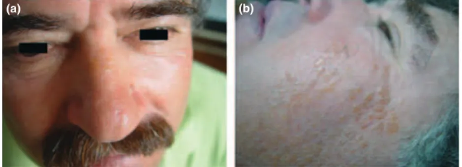 Figure 1 (a) Patient 1 – 55-year-old brother with multiple yellow, translucent papules on his nose