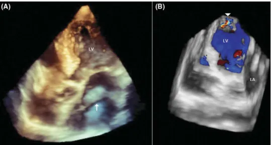 Figure 5 Angiogram with catheter tip in left coronary artery.