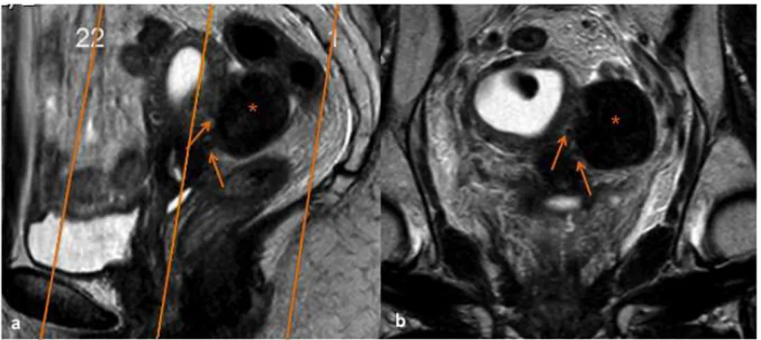 Figura 3 – (a) Sagital T2 de  RM pélvica no qual é marcado  o plano coronal do corpo do  útero, paralelo ao maior eixo  do corpo do útero e à cavidade  endometrial (linhas) para estudo  de lesão pélvica em localização  superior/posterior ao útero