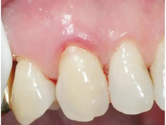 Figura nº 9 - Inflamação gengival adjacente a  uma restauração dentária (Classe V de Black)  com  uma  resina  composta