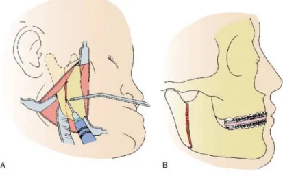 Figura 5 – Abordagem extra-oral  