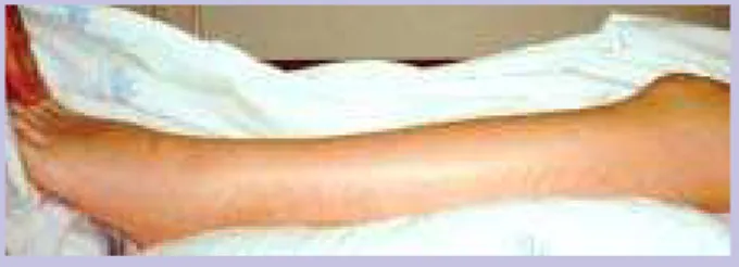 Figura 1 – Sinais inflamatórios da perna esquerda.