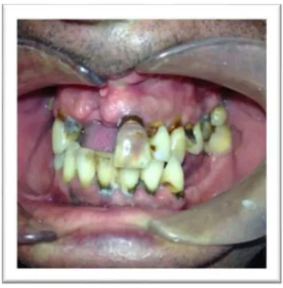 Fig. 4 – Vista frontal inicial das peças dentárias          Fig. 5 – Vista lateral inicial das peças dentárias 