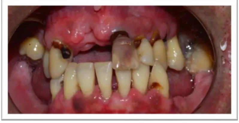 Fig. 13 – Após a destartarização 