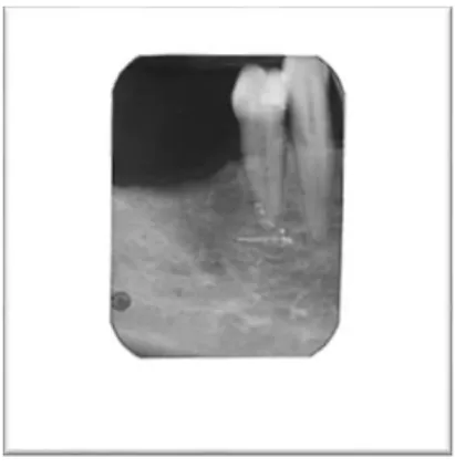 Fig. 24 – Radiografia periapical inicial do dente 4.4  