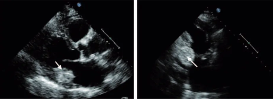 Figure 1 Two-dimensional echocardiogram, parasternal long-axis view (A) and apical two-chamber view (B), revealing an echodense mass at the base of the posterior leaﬂet.