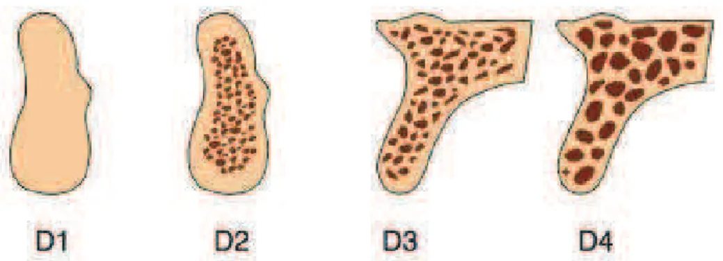 Figura 2 - Classificação da densidade óssea proposta por Misch (1988), retirado de Misch,  (2008)