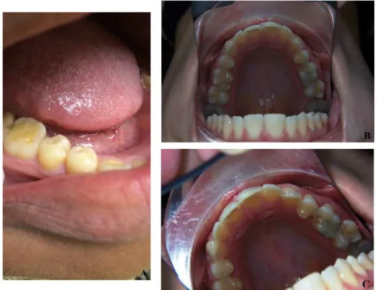 Figura 2-Imagens alusivas à erosão dentária – imagens cedidas pela Prof. Doutora Cristina Manso  A-Cupping de esmalte  