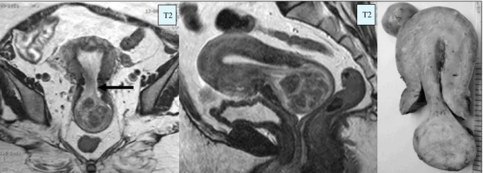 Fig. 2 -  RM e secção  sagital da  peça operatória de  histerectomia. Prolapso de  leiomioma submucoso  em doente de  48 anos.