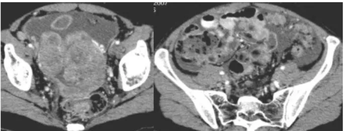 Fig. 14 - Rotura de endometrioma do ovário, com distorsão da forma. A porção mais fina e irregular da parede é o local de rotura (seta)