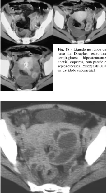 Fig. 17 - Mulher de 50 anos com DIU - tumor anexial complexo à direita.